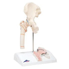 Femur fracture and wear of the hip joint - Anatomy and pathology